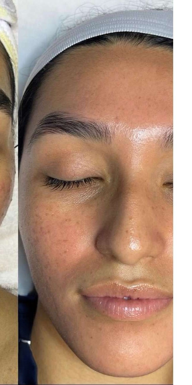 Client skin after treatment